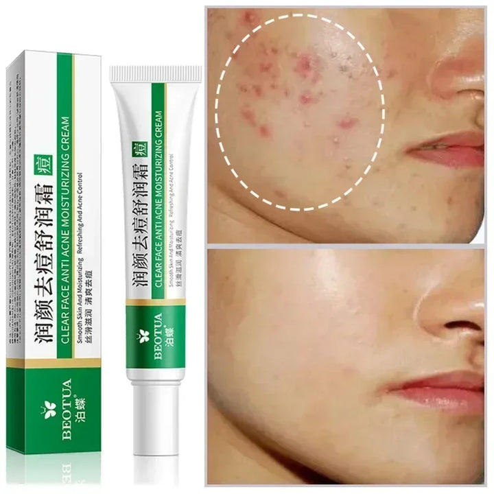 Korean Acne Treatment Cream - Repair, Control, and Whiten Skin | 20g | Gentle Care