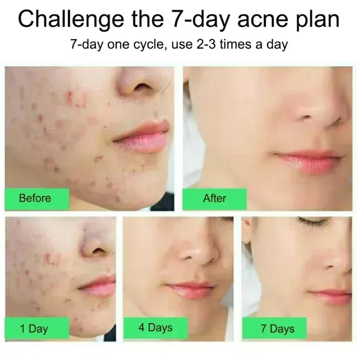 Korean Acne Treatment Cream - Repair, Control, and Whiten Skin | 20g | Gentle Care