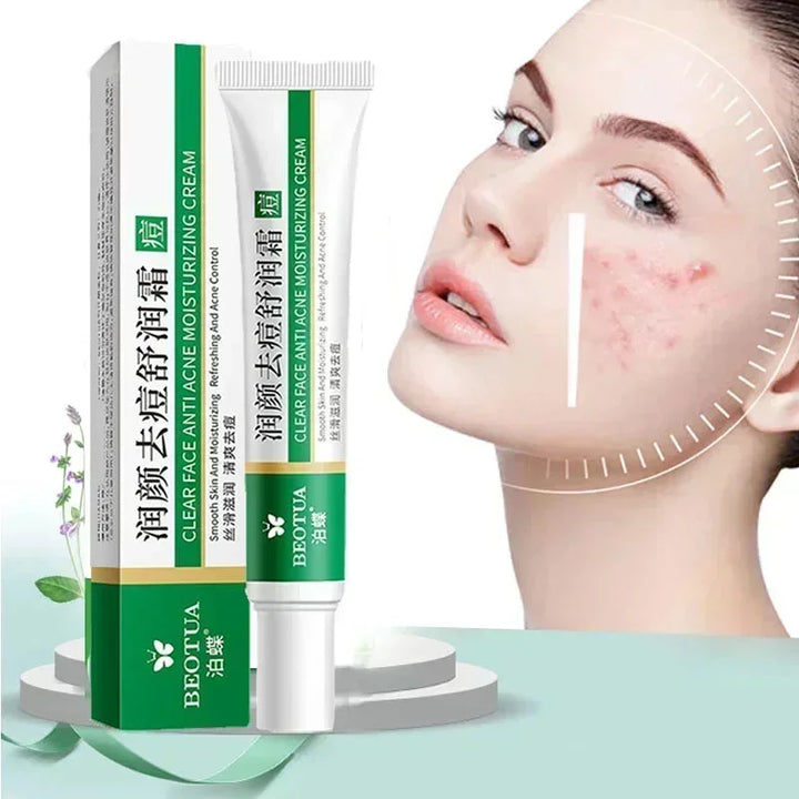 Korean Acne Treatment Cream - Repair, Control, and Whiten Skin | 20g | Gentle Care