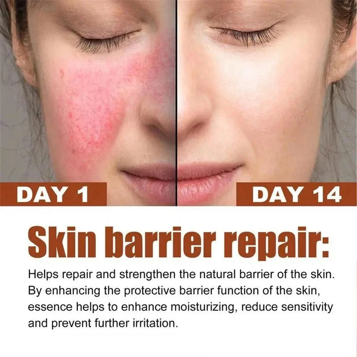 Instant Repair Facial Redness Cream Soothing Red Blood Rosacea Treatment Improve Sensitive Skin Moisturizer Skin Care Cosmetics