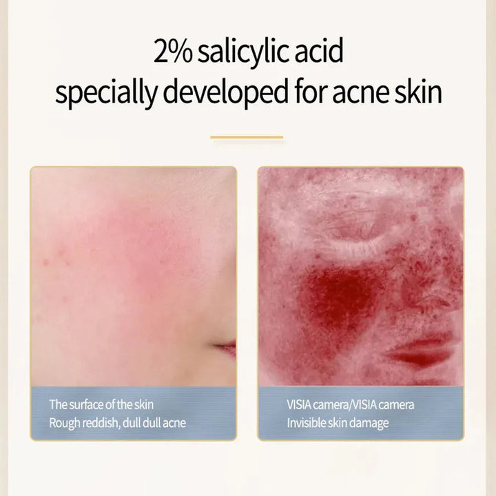 Salicylic Acid Acne Removal Face Serum Acne Treatment Repair Spots Scar Moisturizing Oil Control Shrink Pore Skin Care Products