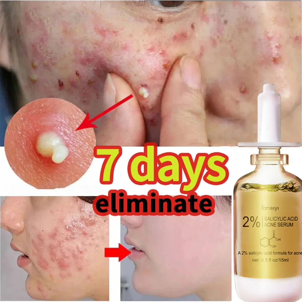 Salicylic Acid Acne Removal Face Serum Acne Treatment Repair Spots Scar Moisturizing Oil Control Shrink Pore Skin Care Products