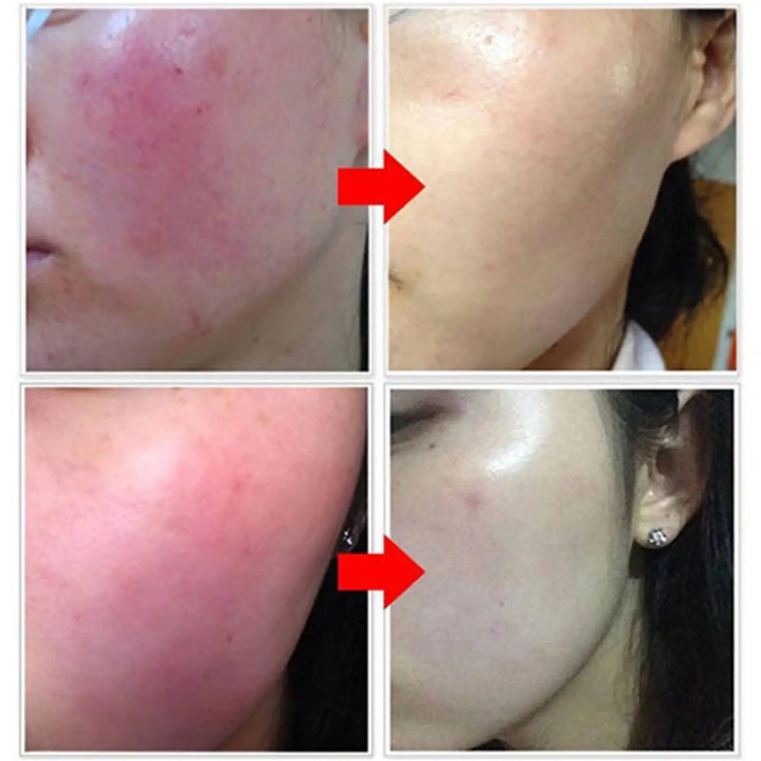 Korean Redness Repair Cream: Soothes & Moisturizes Sensitive Skin