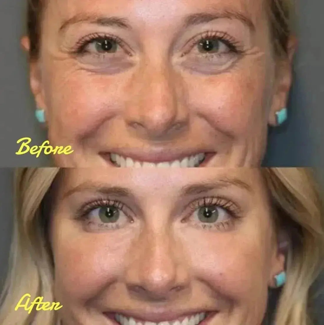 Instant Firm Eye Tightener, Eye cream, eye firming agent, eye lifting, firming, removing eye bags, wrinkle removal, and eye care - ACHETE LTD